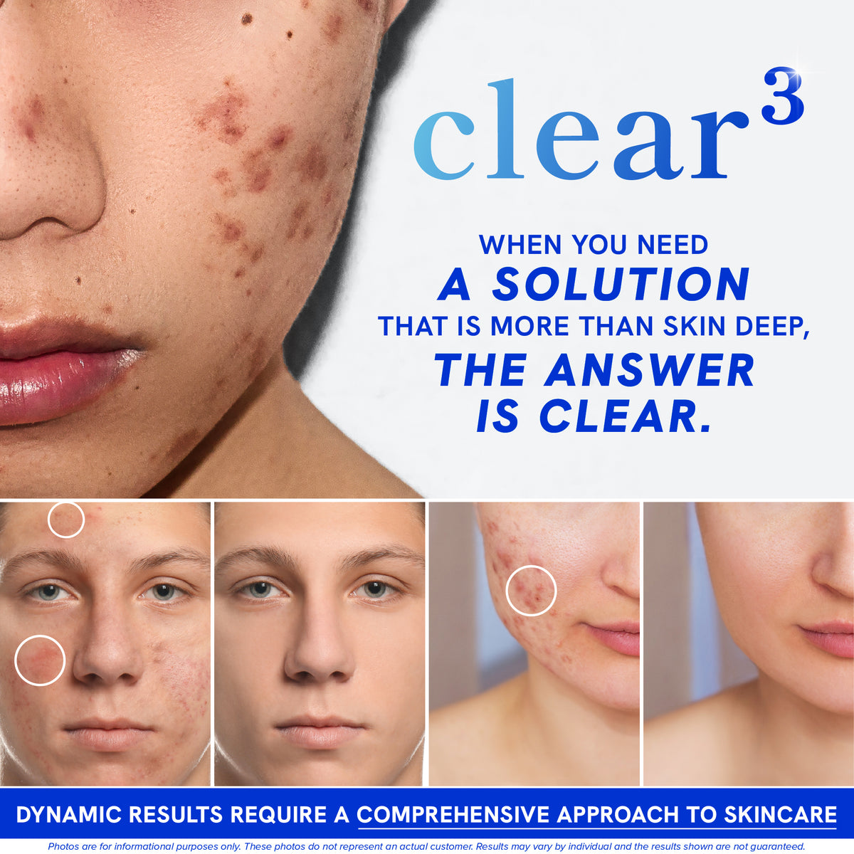 DIM Acne Skin Support