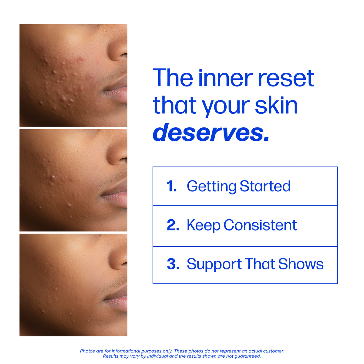 Clear-3 DIM Acne Capsules