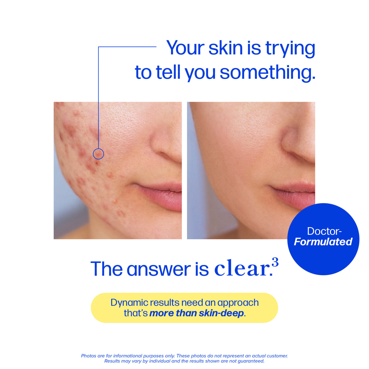Clear-3 DIM Acne Capsules